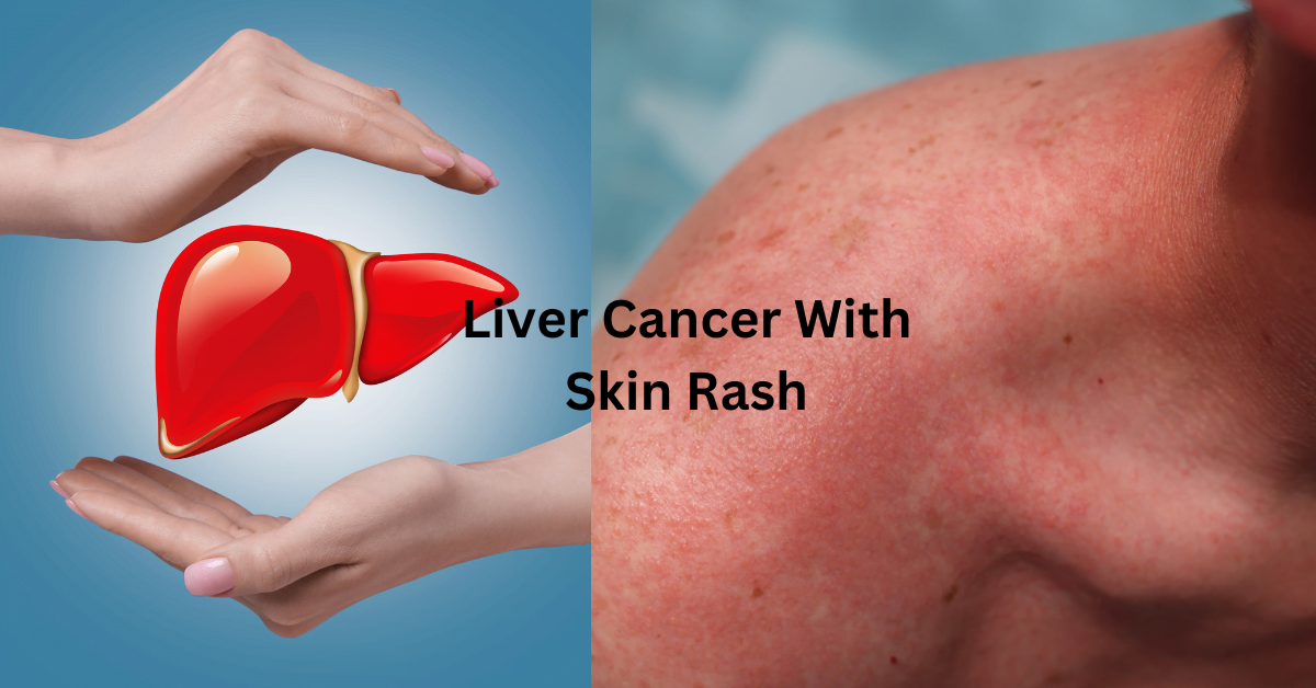 Understanding Liver Cancer Skin Rash In 2023: In Simple Way